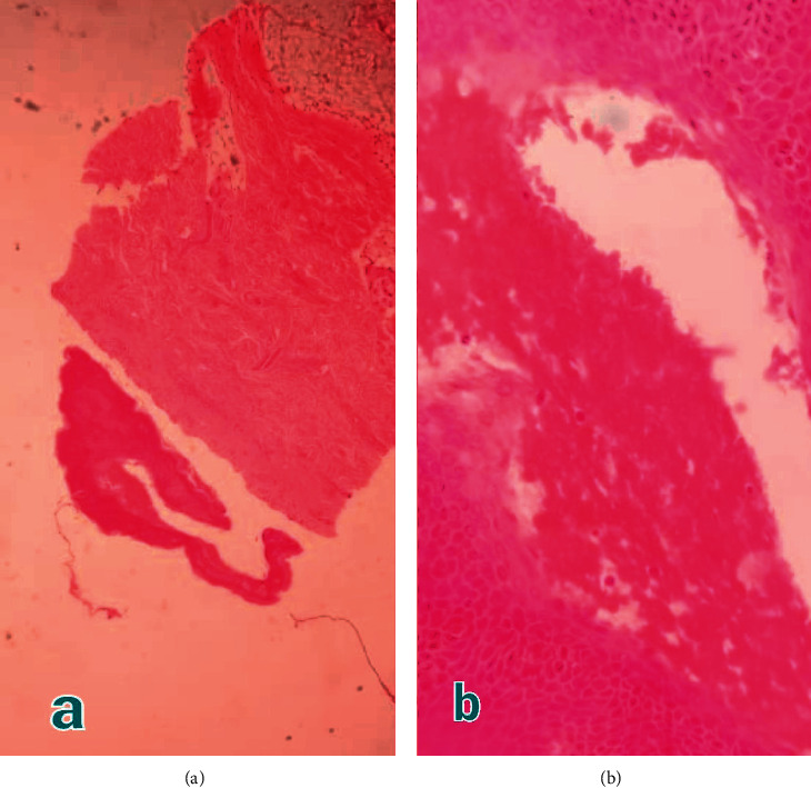 An Unusual TEN-Like Presentation of Juvenile Bullous Pemphigoid: A Diagnostic Challenge.