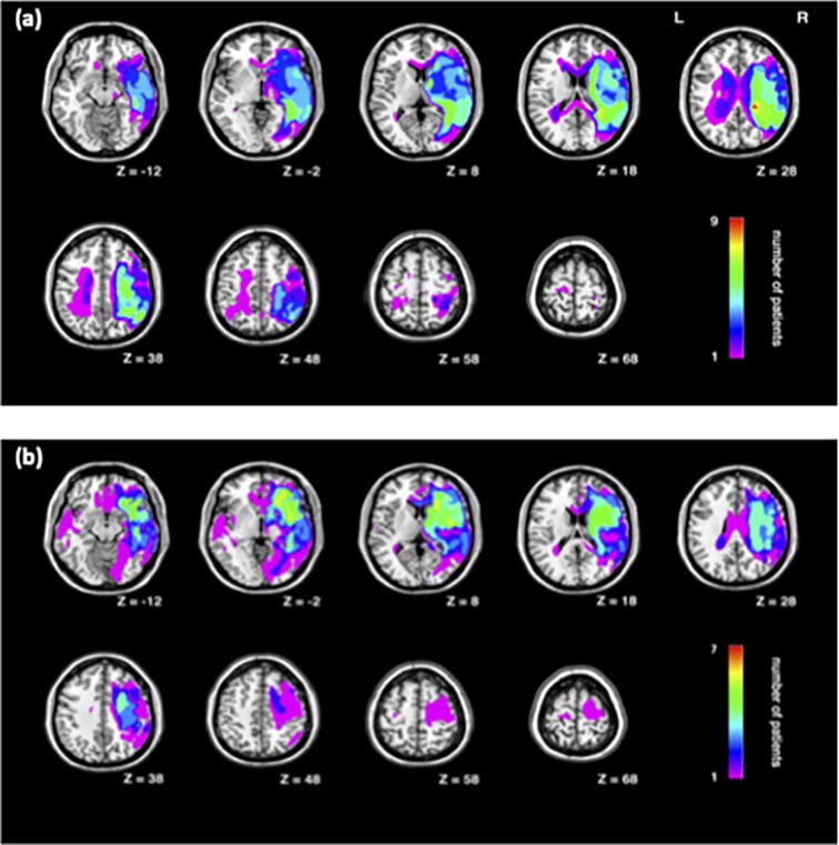 The role of the parietal cortex in inhibitory processing in the vertical meridian: Evidence from elderly brain damaged patients