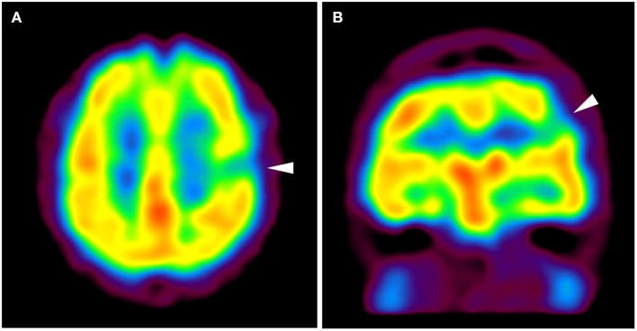 Case report: The origin of transmantle-like features.