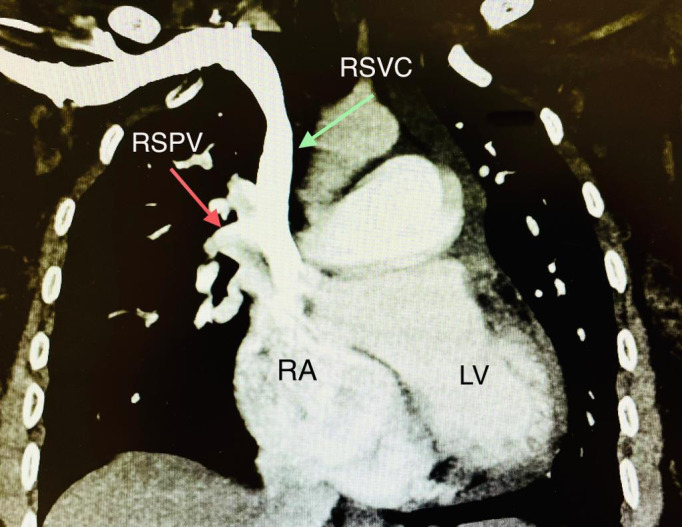 Point-of-Care Ultrasound to Detect Dilated Coronary Sinus in Adults.