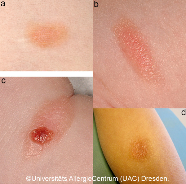 Cutaneous mastocytosis in childhood.