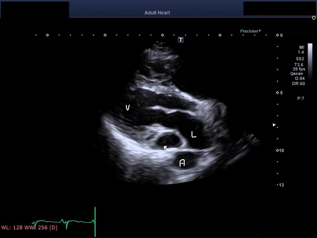 Point-of-Care Ultrasound to Detect Dilated Coronary Sinus in Adults.