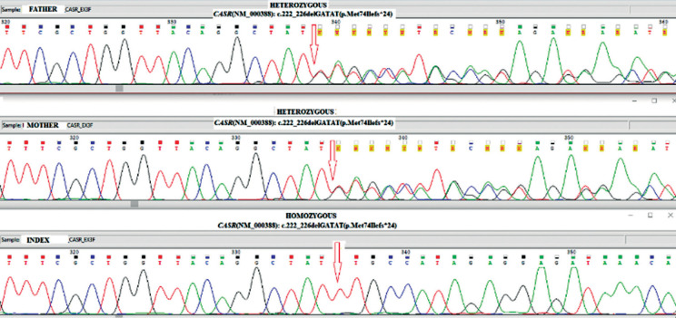 The efficiency of cinacalcet treatment in delaying parathyroidectomy in a case with neonatal severe hyperparathyroidism caused by homozygous mutation in the CASR gene.