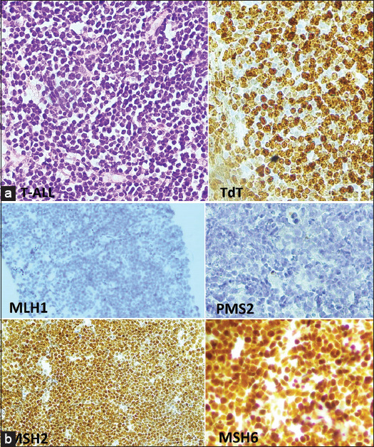 Presentation of Acute Lymphoblastic Lymphoma and Colorectal Carcinoma in the Context of Constitutional Mismatch Repair Deficiency Syndrome: A Case Report with Literature Review.