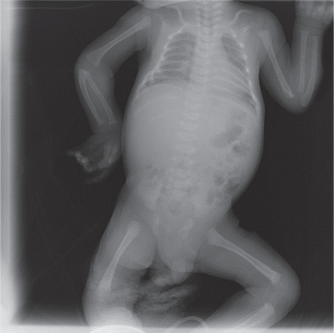 The efficiency of cinacalcet treatment in delaying parathyroidectomy in a case with neonatal severe hyperparathyroidism caused by homozygous mutation in the CASR gene.