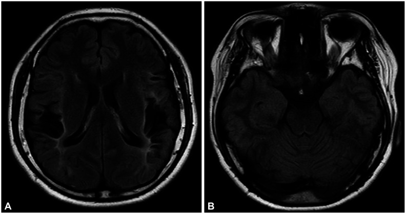 Autoimmune Encephalitis as an Adverse Event of COVID-19 Vaccination.