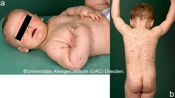 Cutaneous mastocytosis in childhood.