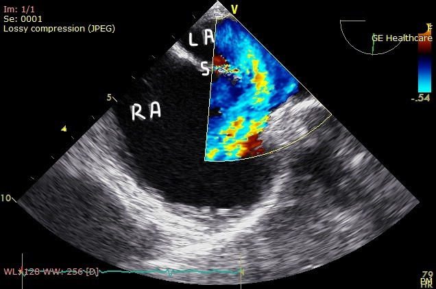 Point-of-Care Ultrasound to Detect Dilated Coronary Sinus in Adults.