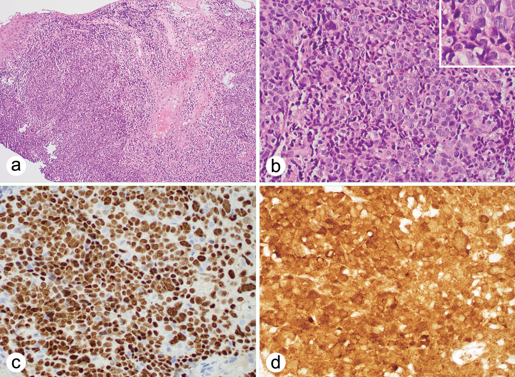 Emerging Trends in the Pathological Research of Human Papillomavirus-positive Oropharyngeal Squamous Cell Carcinoma.