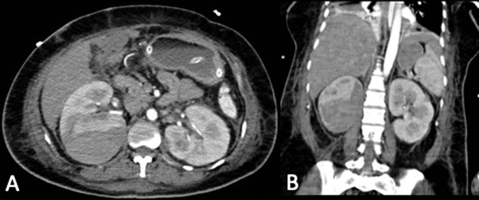 Unusual Presentation of Wünderlich Syndrome.