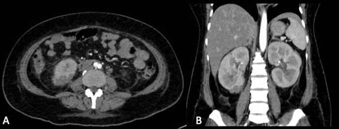 Unusual Presentation of Wünderlich Syndrome.