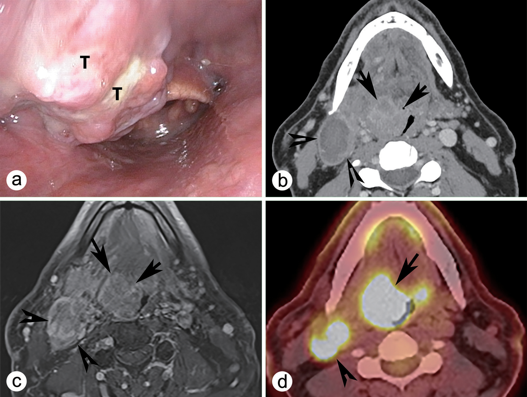 Emerging Trends in the Pathological Research of Human Papillomavirus-positive Oropharyngeal Squamous Cell Carcinoma.