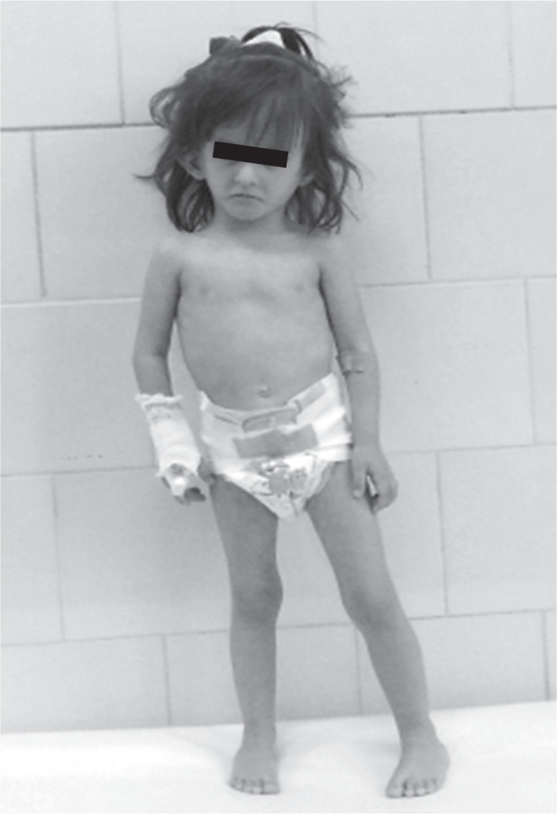 Silver-Russell syndrome and Turner syndrome in a girl with short stature treated with growth hormone - case report.