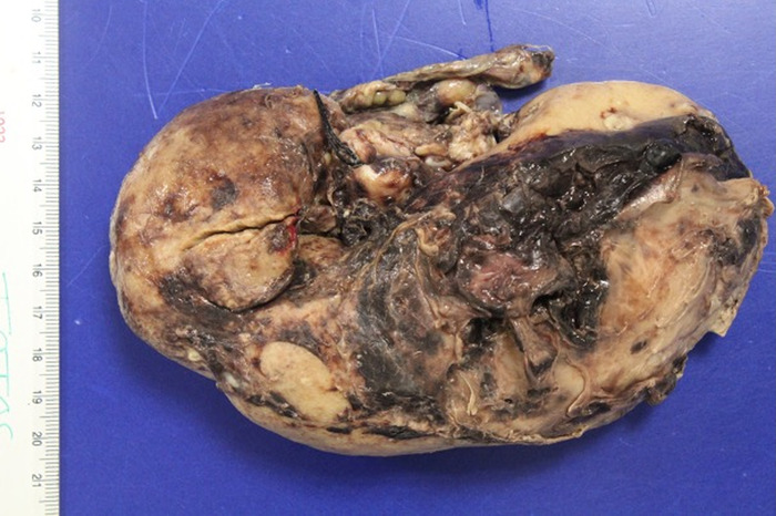 Unusual Presentation of Wünderlich Syndrome.