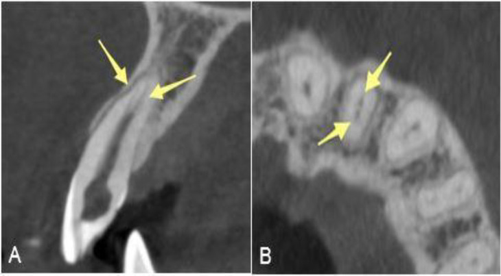 A Maxillary Lateral Incisor with Type V Canal Morphology: A Case Report.