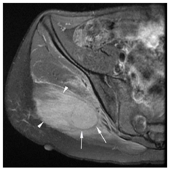 Myositis ossificans in a child athlete: a case study.
