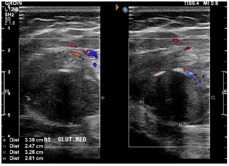 Myositis ossificans in a child athlete: a case study.