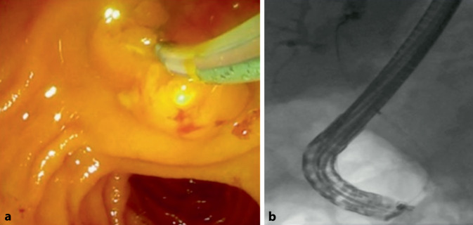 [Single-use products in endoscopy-from consumables to single-use scopes].