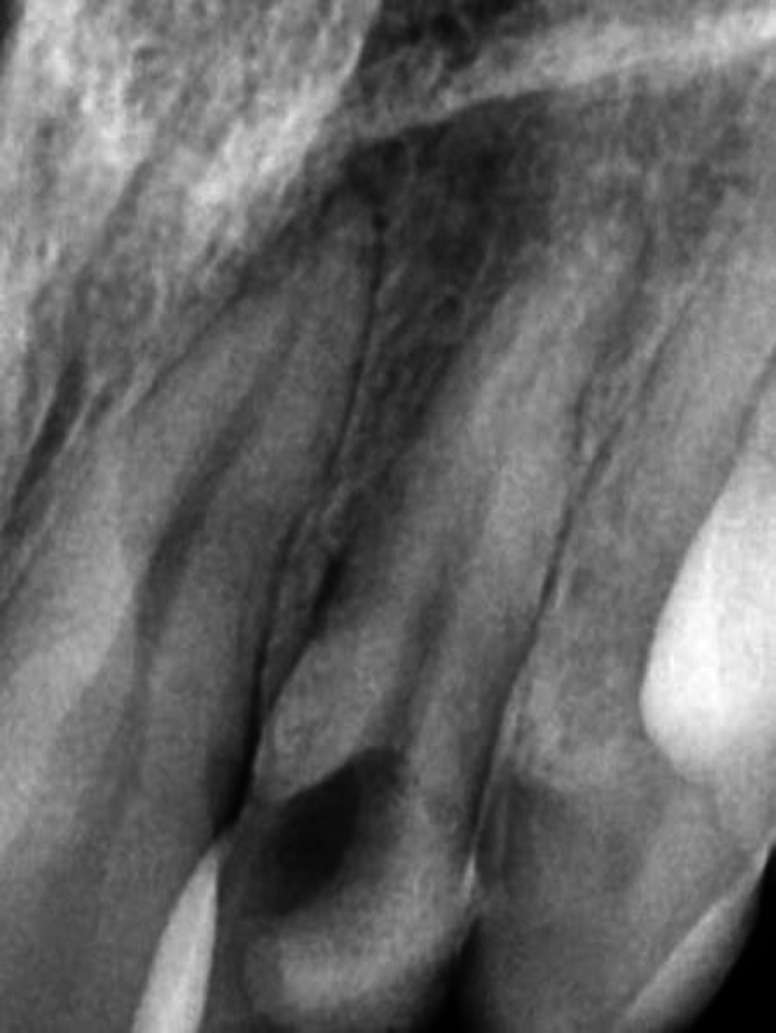 A Maxillary Lateral Incisor with Type V Canal Morphology: A Case Report.