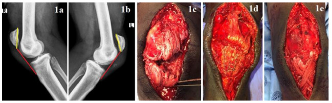 Bilateral patellar tendon rupture in a weightlifter during an acute high-loading resistance exercise bout: A case study.