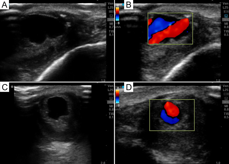 A Non-Resolving "Hematoma" Diagnosed as an Arteriovenous Malformation by POCUS.