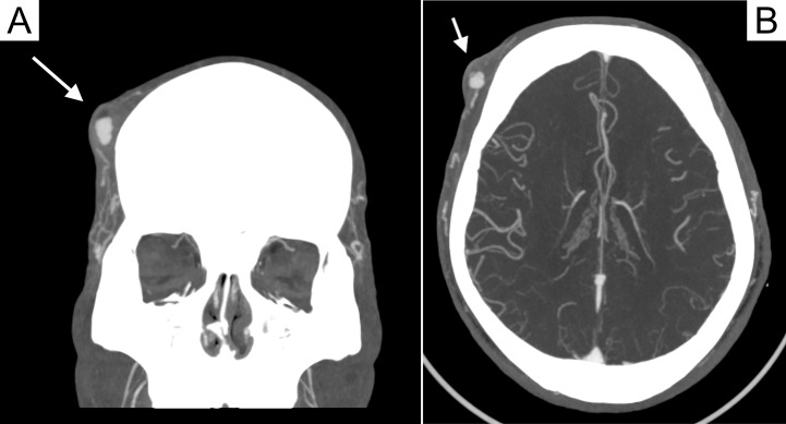 A Non-Resolving "Hematoma" Diagnosed as an Arteriovenous Malformation by POCUS.