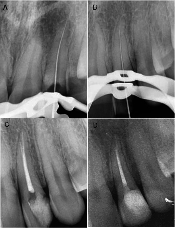 A Maxillary Lateral Incisor with Type V Canal Morphology: A Case Report.