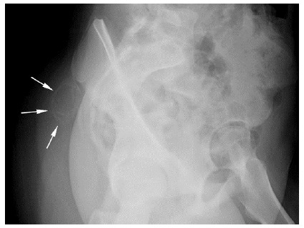 Myositis ossificans in a child athlete: a case study.