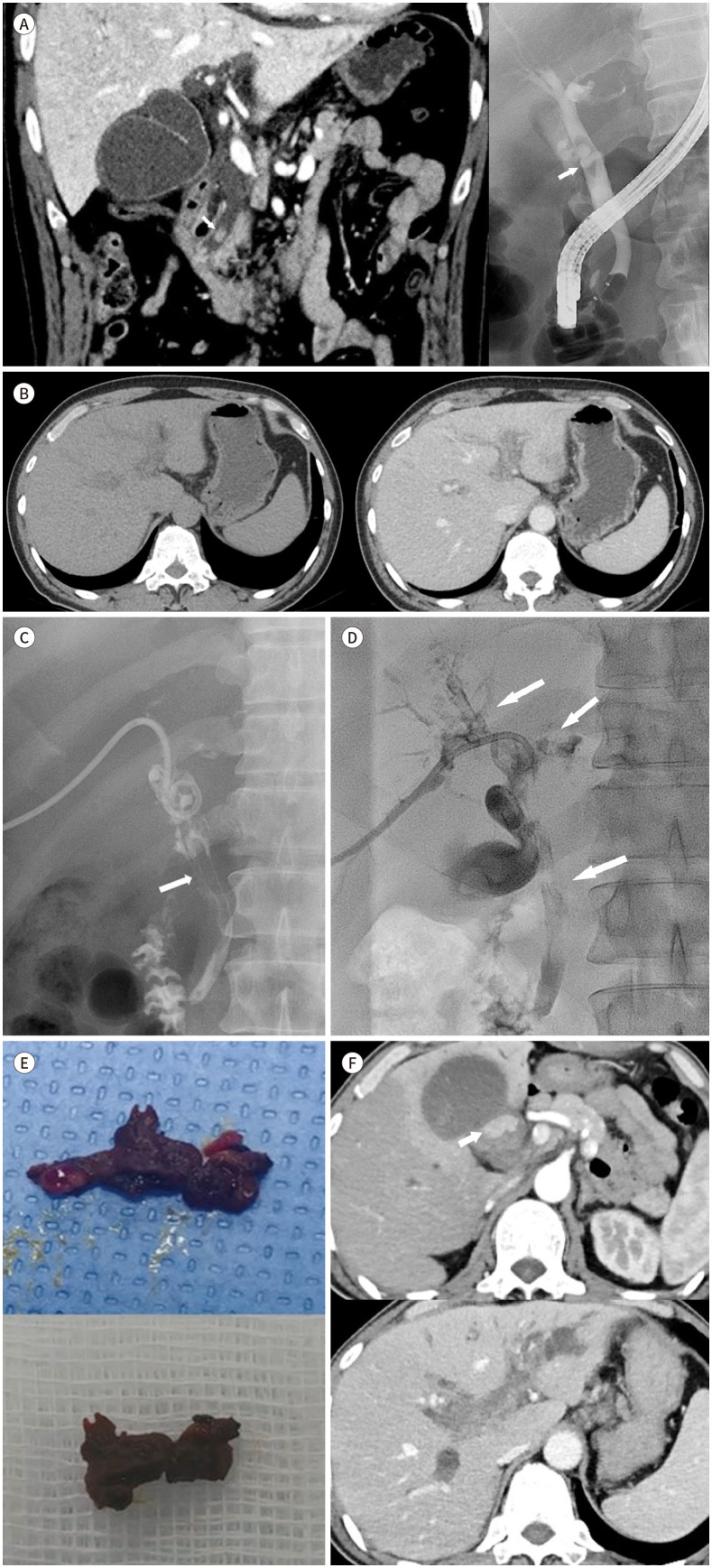A Case of Biliary Cast Syndrome After Endoscopic and Percutaneous Management of Common Bile Duct Stone.