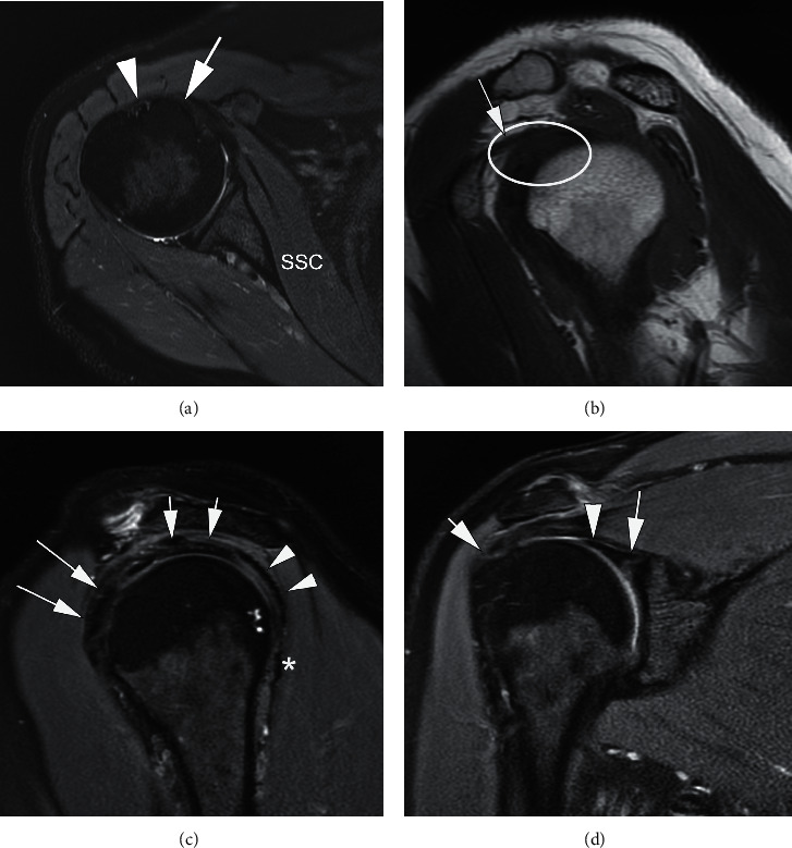 Imaging Review of Subscapularis Tendon and Rotator Interval Pathology.