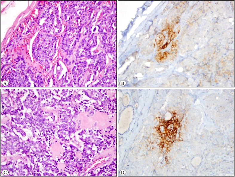 PD-L1 Expression in Medullary Thyroid Carcinoma and Its Association with Clinicopathological Findings.