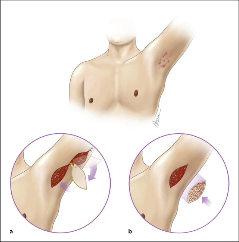 Outcome Comparison of Different Reconstructive Approaches for Axillary Defects Secondary to Radical Excision of Hidradenitis Suppurativa.