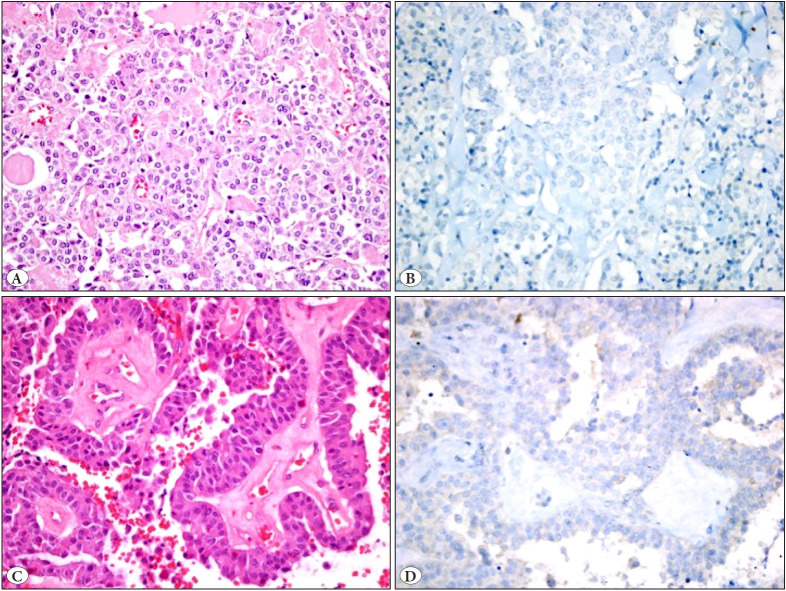 PD-L1 Expression in Medullary Thyroid Carcinoma and Its Association with Clinicopathological Findings.