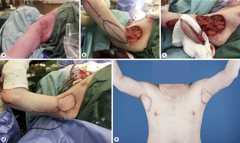 Outcome Comparison of Different Reconstructive Approaches for Axillary Defects Secondary to Radical Excision of Hidradenitis Suppurativa.