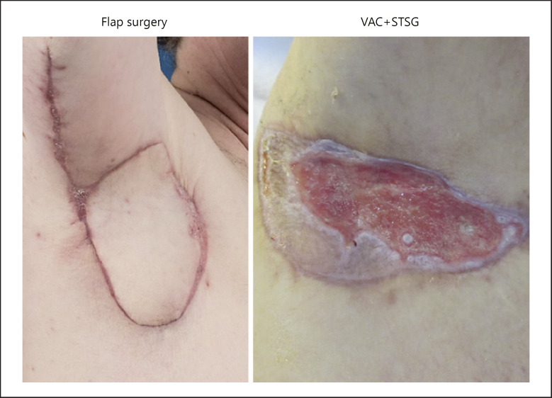 Outcome Comparison of Different Reconstructive Approaches for Axillary Defects Secondary to Radical Excision of Hidradenitis Suppurativa.