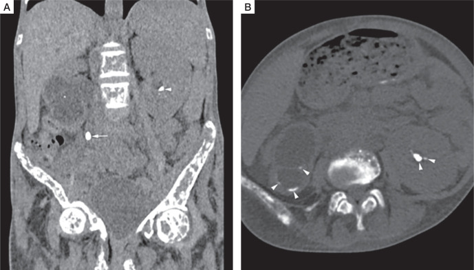 Atypical parathyroid adenoma: Severe manifestations in an adolescent girl.