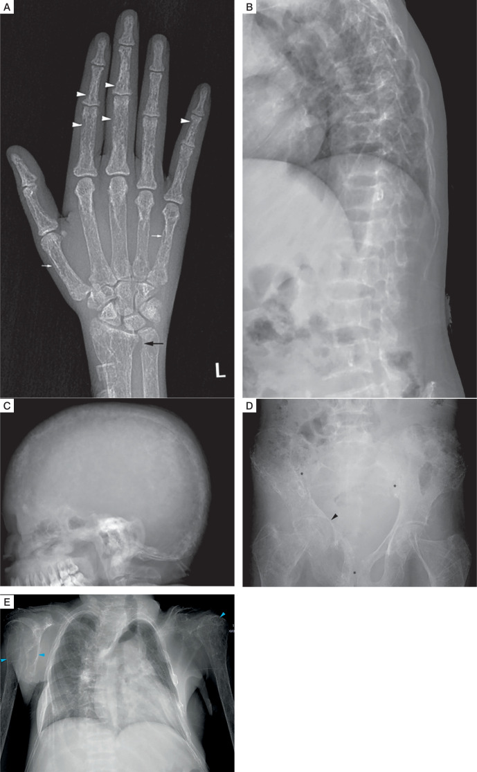 Atypical parathyroid adenoma: Severe manifestations in an adolescent girl.