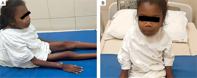 Atypical parathyroid adenoma: Severe manifestations in an adolescent girl.