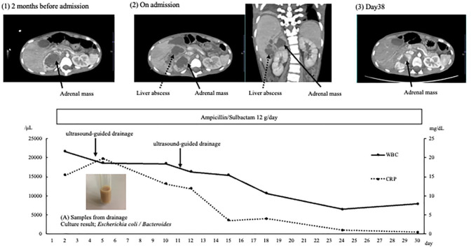 A case of pheochromocytoma associated with liver abscess and intestinal pseudo-obstruction.