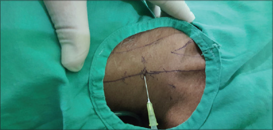 A Prospective Observational Study of the Efficacy of Combined Interscalene Block and Superficial Cervical Plexus Block using Peripheral Nerve Stimulator and Landmark-Based Technique, as a Sole Anesthetic for Surgeries on the Clavicle in the COVID-19 Pandemic.