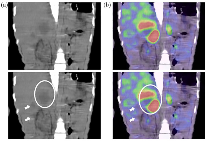 A case of pheochromocytoma associated with liver abscess and intestinal pseudo-obstruction.