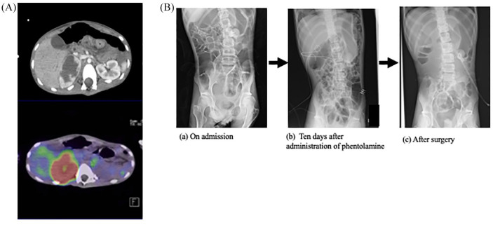 A case of pheochromocytoma associated with liver abscess and intestinal pseudo-obstruction.