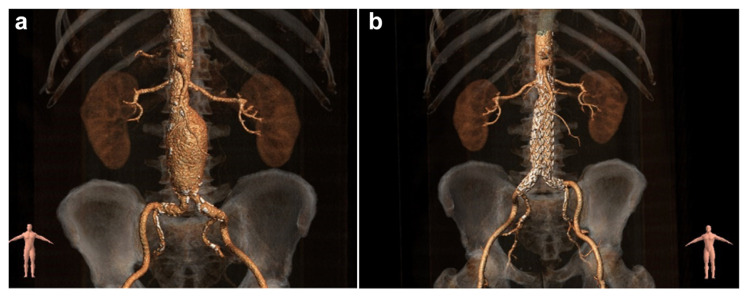 Abdominal Aortic Aneurysm: Natural History, Pathophysiology and Translational Perspectives.