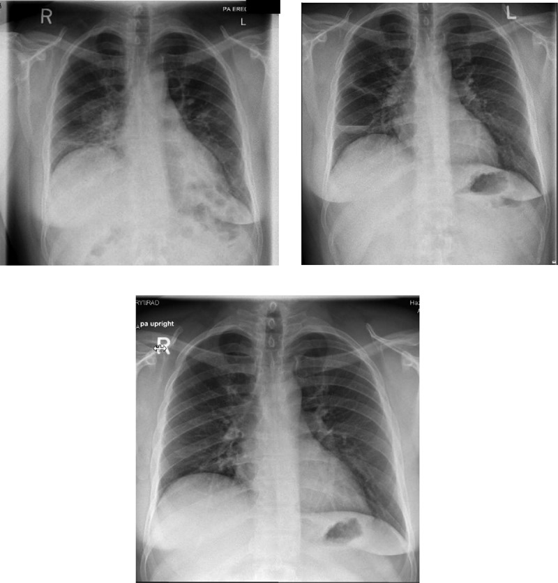 Post-COVID-19 pneumonia pneumatoceles: a case report.