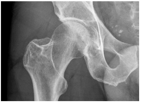 Acetabular fracture after cycling related falls: High index of suspicion is required to avoid missing the injury on plain radiographs.