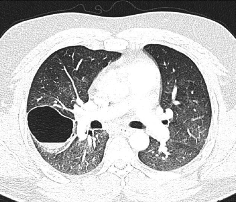 Post-COVID-19 pneumonia pneumatoceles: a case report.