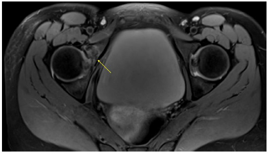 Acetabular fracture after cycling related falls: High index of suspicion is required to avoid missing the injury on plain radiographs.