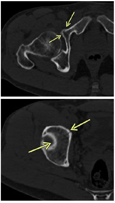 Acetabular fracture after cycling related falls: High index of suspicion is required to avoid missing the injury on plain radiographs.