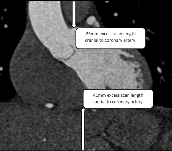 Impact of an ultra-low dose unenhanced planning scan on CT coronary angiography scan length and effective radiation dose.