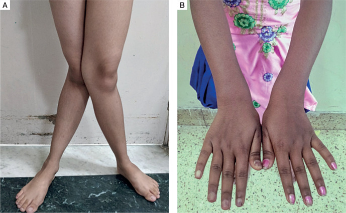 The spectrum of manifestations of primary hyperparathyroidism in children and adolescents.